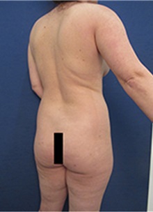 Buttock Lift with Augmentation Before Photo by Arian Mowlavi, MD; Laguna Beach, CA - Case 35443