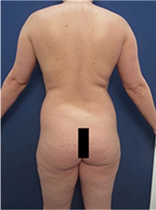Buttock Lift with Augmentation Before Photo by Arian Mowlavi, MD; Laguna Beach, CA - Case 35443