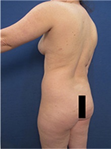 Liposuction Before Photo by Arian Mowlavi, MD; Laguna Beach, CA - Case 35452
