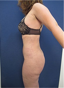 Liposuction After Photo by Arian Mowlavi, MD; Laguna Beach, CA - Case 35452