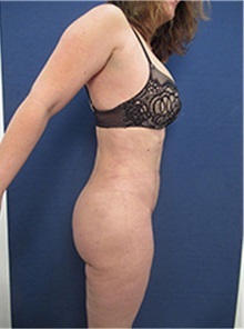 Liposuction After Photo by Arian Mowlavi, MD; Laguna Beach, CA - Case 35452