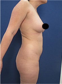 Liposuction Before Photo by Arian Mowlavi, MD; Laguna Beach, CA - Case 35452