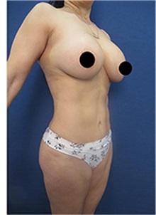 Liposuction After Photo by Arian Mowlavi, MD; Laguna Beach, CA - Case 35457