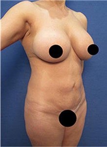Liposuction Before Photo by Arian Mowlavi, MD; Laguna Beach, CA - Case 35457