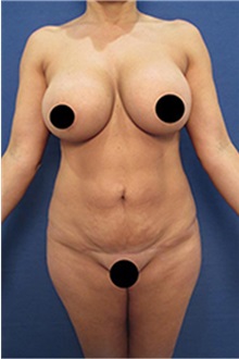 Liposuction Before Photo by Arian Mowlavi, MD; Laguna Beach, CA - Case 35457