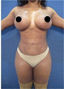 Breast Augmentation After Photo by Arian Mowlavi, MD; Laguna Beach, CA - Case 35460
