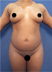 Breast Augmentation Before Photo by Arian Mowlavi, MD; Laguna Beach, CA - Case 35460