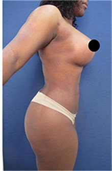 Breast Augmentation Before Photo by Arian Mowlavi, MD; Laguna Beach, CA - Case 35460