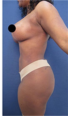 Buttock Lift with Augmentation After Photo by Arian Mowlavi, MD; Laguna Beach, CA - Case 35462