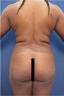 Buttock Lift with Augmentation Before Photo by Arian Mowlavi, MD; Laguna Beach, CA - Case 35462