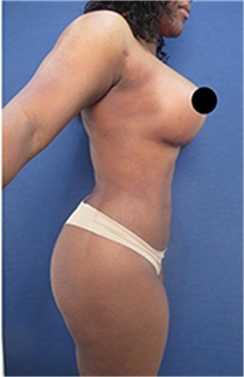 Buttock Lift with Augmentation After Photo by Arian Mowlavi, MD; Laguna Beach, CA - Case 35462
