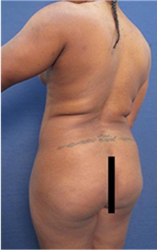 Buttock Lift with Augmentation Before Photo by Arian Mowlavi, MD; Laguna Beach, CA - Case 35462