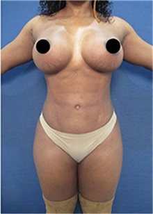 Liposuction After Photo by Arian Mowlavi, MD; Laguna Beach, CA - Case 35463