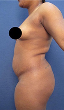Liposuction Before Photo by Arian Mowlavi, MD; Laguna Beach, CA - Case 35463