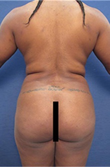 Liposuction Before Photo by Arian Mowlavi, MD; Laguna Beach, CA - Case 35463