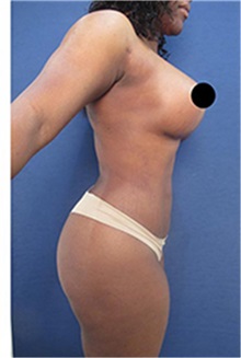 Liposuction After Photo by Arian Mowlavi, MD; Laguna Beach, CA - Case 35463