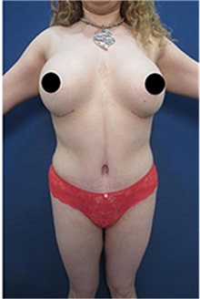 Breast Augmentation After Photo by Arian Mowlavi, MD; Laguna Beach, CA - Case 35551