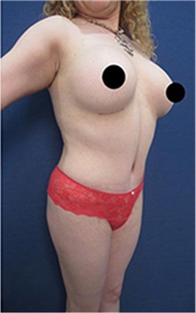 Breast Augmentation After Photo by Arian Mowlavi, MD; Laguna Beach, CA - Case 35551