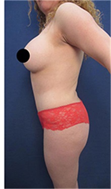 Liposuction After Photo by Arian Mowlavi, MD; Laguna Beach, CA - Case 35552