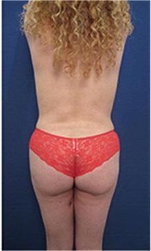Liposuction After Photo by Arian Mowlavi, MD; Laguna Beach, CA - Case 35552
