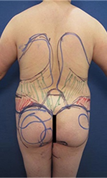 Liposuction Before Photo by Arian Mowlavi, MD; Laguna Beach, CA - Case 35552