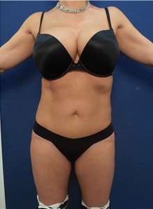 Liposuction After Photo by Arian Mowlavi, MD; Laguna Beach, CA - Case 35599