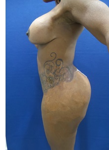 Breast Augmentation After Photo by Arian Mowlavi, MD; Laguna Beach, CA - Case 35604