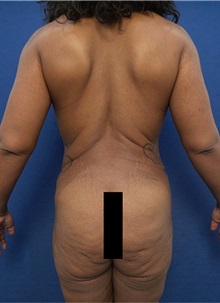Breast Augmentation Before Photo by Arian Mowlavi, MD; Laguna Beach, CA - Case 35604