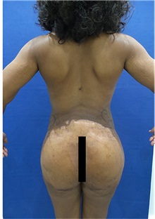 Buttock Lift with Augmentation After Photo by Arian Mowlavi, MD; Laguna Beach, CA - Case 35605