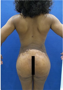 Buttock Implants After Photo by Arian Mowlavi, MD; Laguna Beach, CA - Case 35607