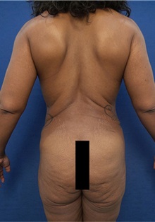 Buttock Implants Before Photo by Arian Mowlavi, MD; Laguna Beach, CA - Case 35607