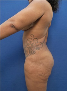 Buttock Implants Before Photo by Arian Mowlavi, MD; Laguna Beach, CA - Case 35607
