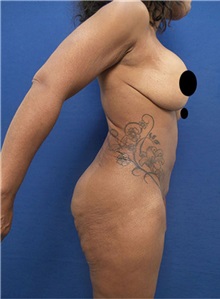 Liposuction Before Photo by Arian Mowlavi, MD; Laguna Beach, CA - Case 35608