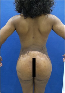 Liposuction After Photo by Arian Mowlavi, MD; Laguna Beach, CA - Case 35608
