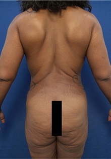Liposuction Before Photo by Arian Mowlavi, MD; Laguna Beach, CA - Case 35608