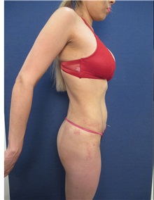 Liposuction After Photo by Arian Mowlavi, MD; Laguna Beach, CA - Case 35611