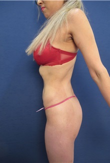 Liposuction After Photo by Arian Mowlavi, MD; Laguna Beach, CA - Case 35611