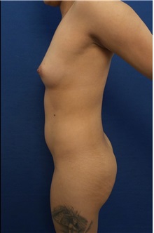 Breast Augmentation Before Photo by Arian Mowlavi, MD; Laguna Beach, CA - Case 35616