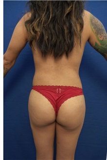Buttock Implants After Photo by Arian Mowlavi, MD; Laguna Beach, CA - Case 35617