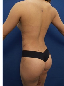 Buttock Lift with Augmentation After Photo by Arian Mowlavi, MD; Laguna Beach, CA - Case 35623