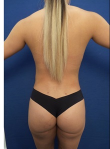 Buttock Lift with Augmentation After Photo by Arian Mowlavi, MD; Laguna Beach, CA - Case 35623