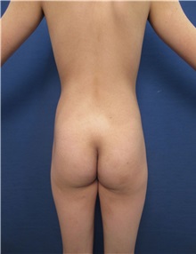Buttock Implants Before Photo by Arian Mowlavi, MD; Laguna Beach, CA - Case 35625