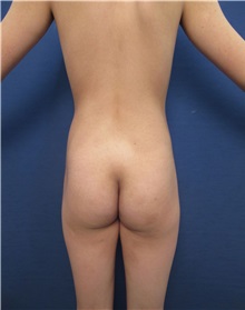 Buttock Lift with Augmentation Before Photo by Arian Mowlavi, MD; Laguna Beach, CA - Case 35626