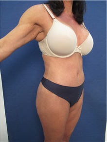Body Contouring After Photo by Arian Mowlavi, MD; Laguna Beach, CA - Case 35914