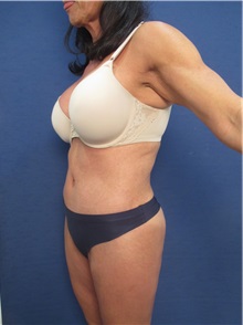 Buttock Lift with Augmentation After Photo by Arian Mowlavi, MD; Laguna Beach, CA - Case 35915