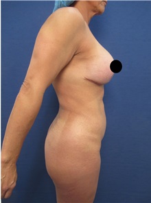 Buttock Lift with Augmentation Before Photo by Arian Mowlavi, MD; Laguna Beach, CA - Case 35915