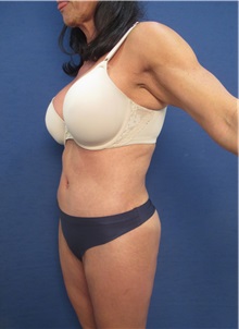Liposuction After Photo by Arian Mowlavi, MD; Laguna Beach, CA - Case 35916