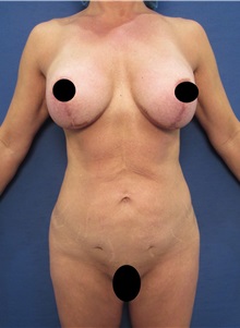 Liposuction Before Photo by Arian Mowlavi, MD; Laguna Beach, CA - Case 35916