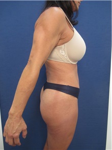 Liposuction After Photo by Arian Mowlavi, MD; Laguna Beach, CA - Case 35916