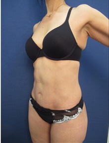 Body Lift After Photo by Arian Mowlavi, MD; Laguna Beach, CA - Case 36190